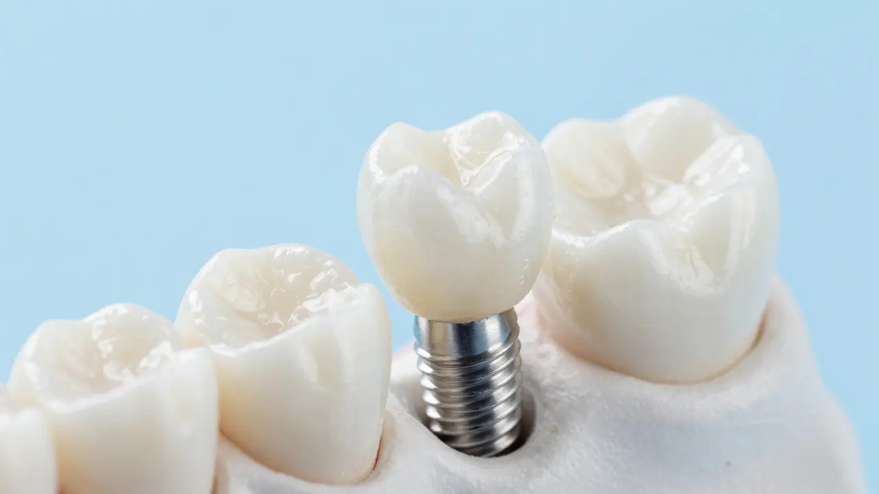 Jaké jsou možnosti náhrady zubu? Přehled moderních řešení