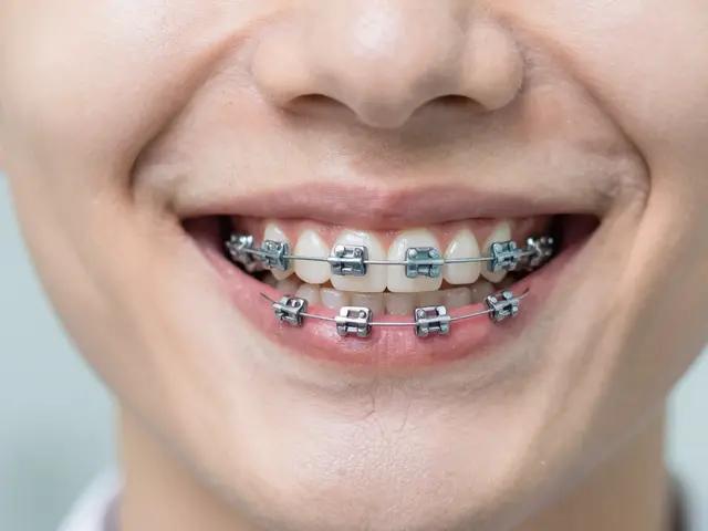 Fixní rovnátka: Odpovědi na 5 nejčastějších otázek pacientů