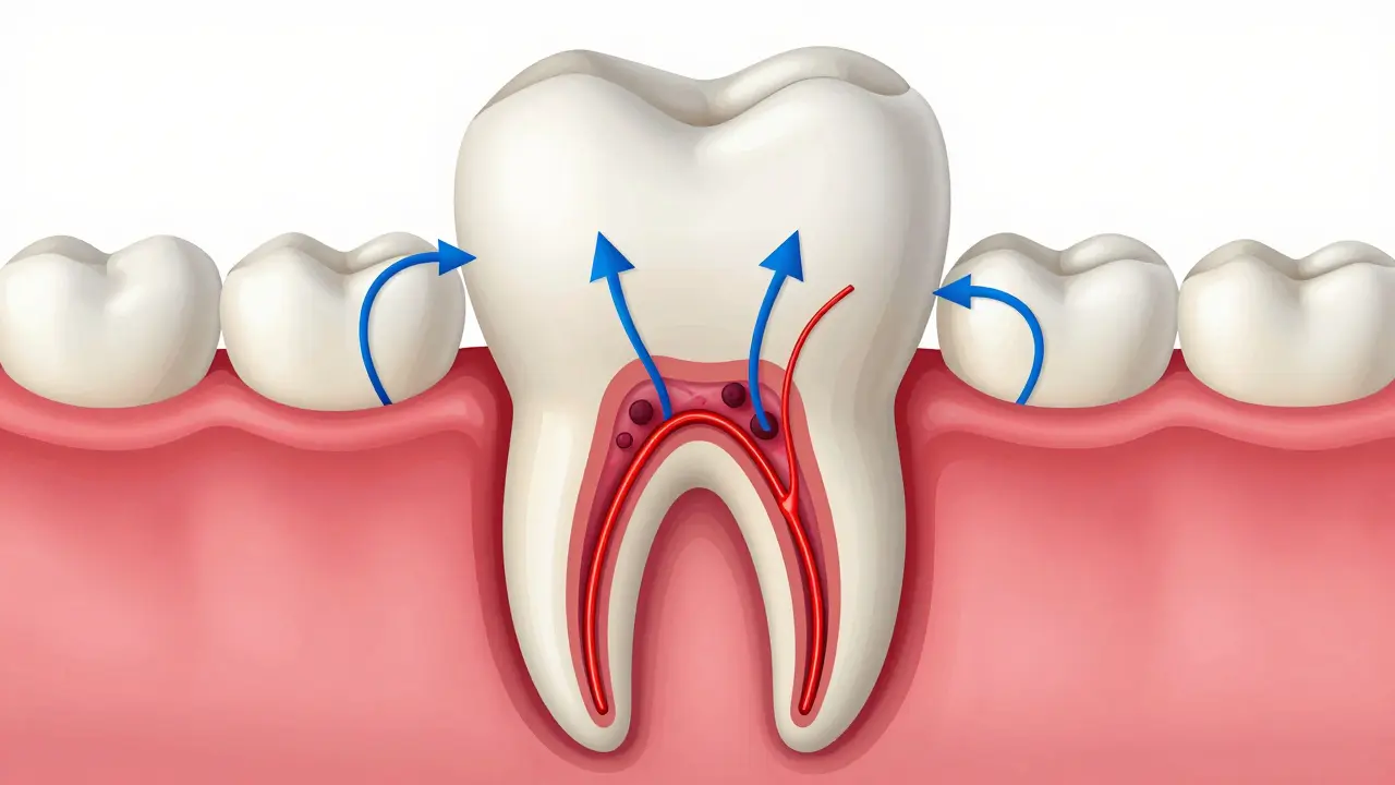 Anatomický průřez zubem ukazující infekci uvnitř a nedostupnost pro léky z krve.